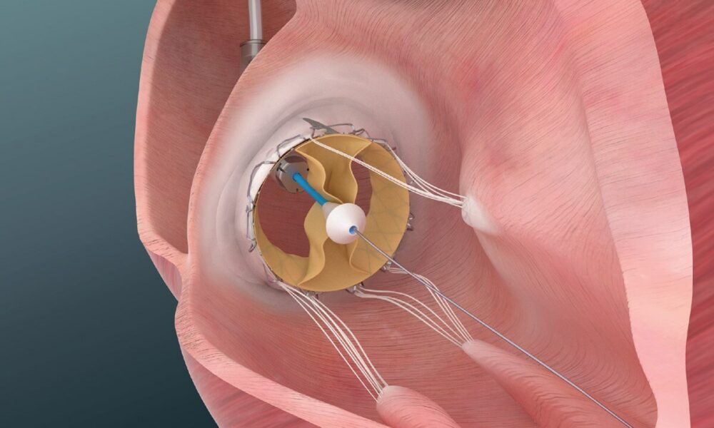 Trisol announces successful implants of its Transcatheter Tricuspid ...